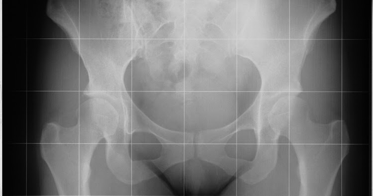 Como sin medicinas aumentar el pene